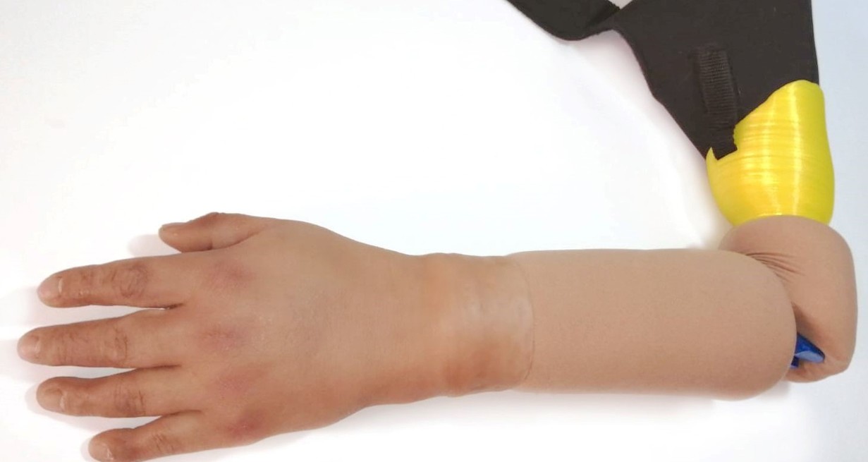 Una prótesis de antebrazo mixta permite recuperar tanto la apertura y cierre de la mano, como el aspecto natural de la mano. Crédito: Gentileza