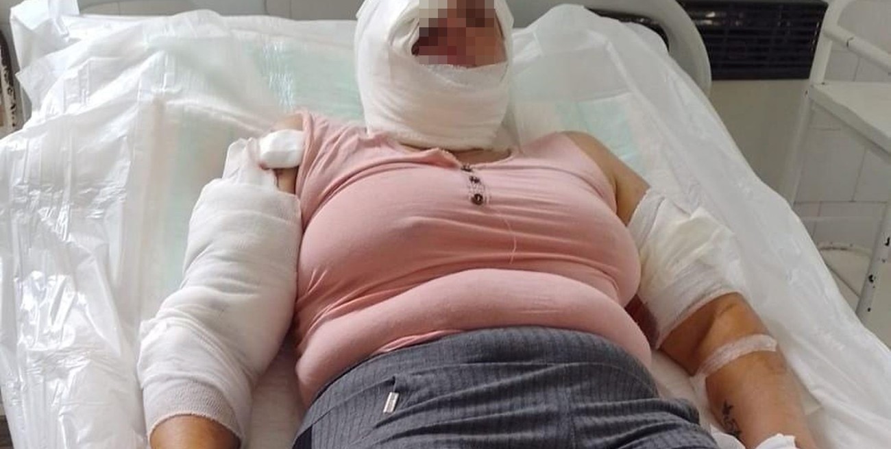 Una mujer de 46 años sufrió graves lesiones por mordeduras de dos pitbulls, cuando rescató a su nieta de un año del ataque. Crédito: El Litoral