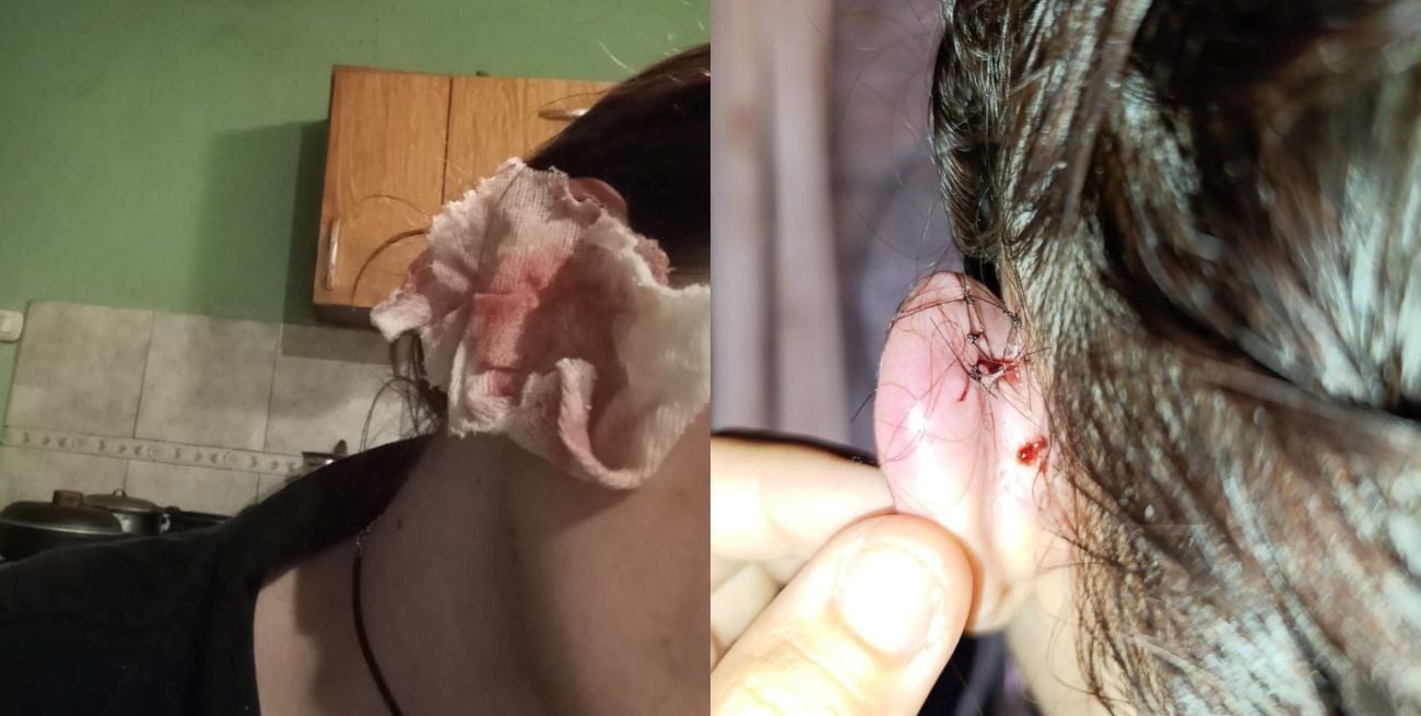 Las heridas que sufrió una joven en su cabeza tras recibir un botellazo.