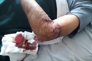 ELLITORAL_378390 |  Gentileza El hombre resultó con lesiones que motivaron varios puntos de sutura y una cirugía de reconstrucción del brazo.