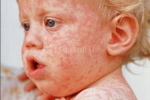 ELLITORAL_438200 |  Gentileza El sarampión suele afectar a niños menores de 5 años, pero en los países donde la vacunación infantil es efectiva, contagia sobre todo a los adultos jóvenes. Las complicaciones son frecuentes, algunas graves, incluso mortales.
