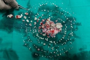 BBC Mundo La operación, hecha el lunes, requirió de dos cirujanos y dos ayudantes. No había visto algo así en mis 30 años de carrera , dijo la doctora que coordinó la intervención.