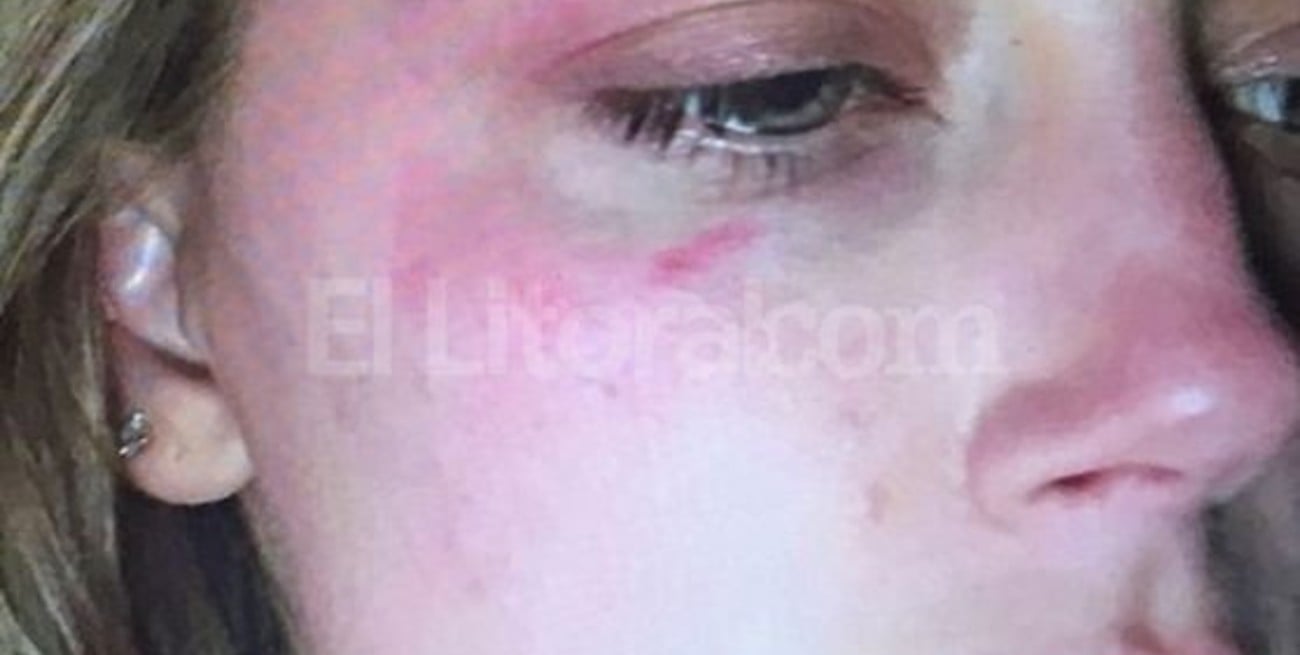 Impactante foto de la esposa de Johnny Depp después de sufrir violencia de género  