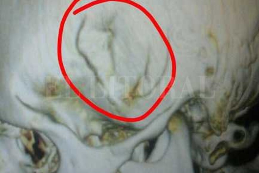 ELLITORAL_174502 |  El Litoral La placa radiográfica que le hicieron al joven donde se señala el daño en el hueso temporal