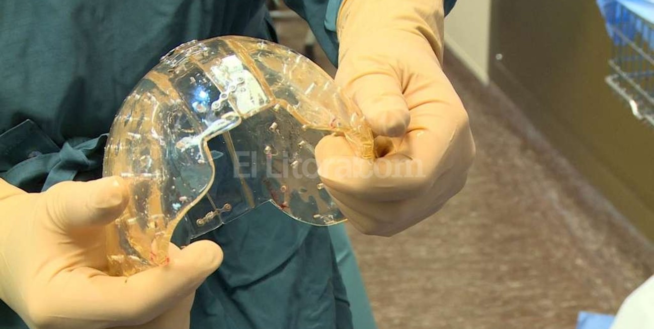 China: trasplantaron parte de un cráneo hecho con una impresora 3D