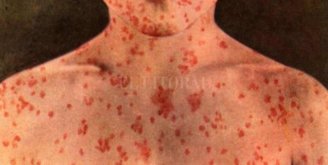 Confirman el primer caso autóctono de sarampión registrado en el país en los últimos 18 años