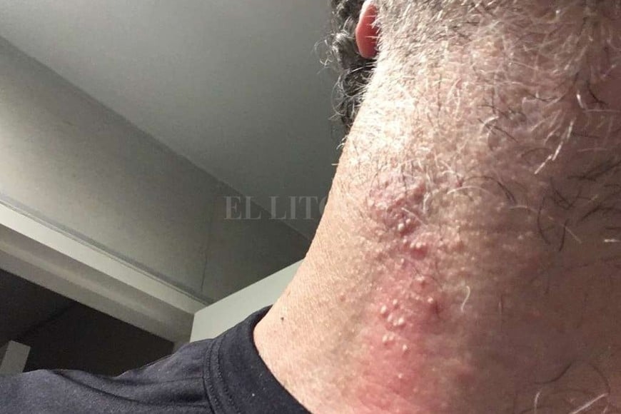 ELLITORAL_193012 | El Litoral Este es un ejemplo de las lesiones que produce el bicho de fuego en la piel.