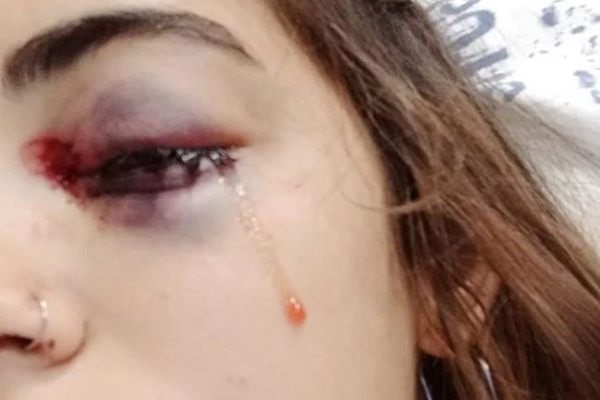 ELLITORAL_356102 |  Gentileza Nerina Moyano casi pierde un ojo en la represión que llevó adelante la Policía de Rojas cuando se movilizaron en reclamo por el femicidio de Úrsula Bahillo.