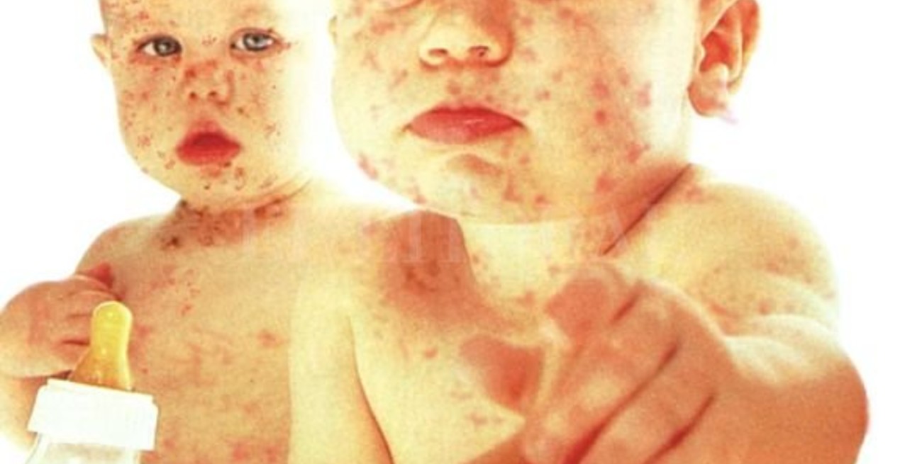 Advertencia de la OMS por un fuerte incremento de los casos de sarampión en el mundo