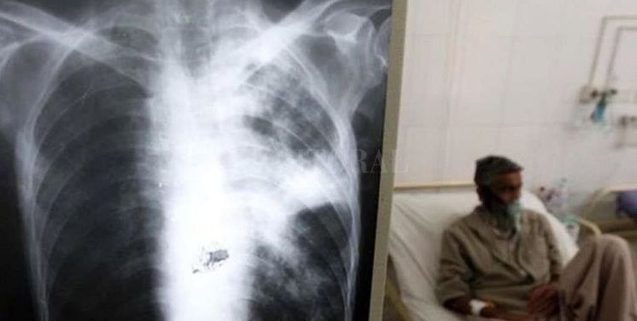 Tuberculosis multirresistente: una amenaza mundial que va en aumento