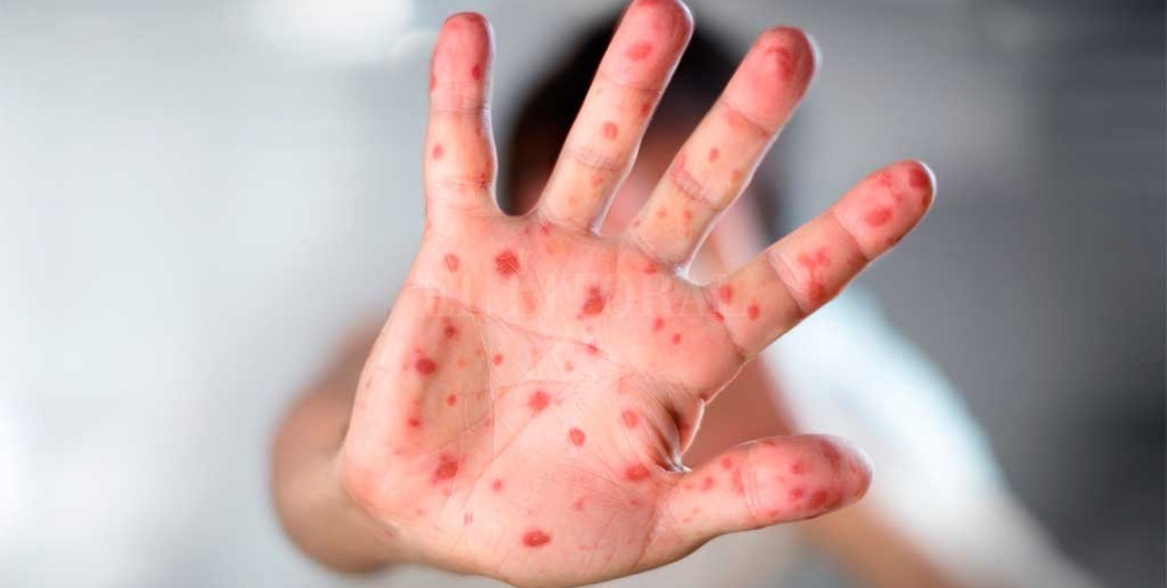 Brote de sarampión: una mujer antivacunas y sus cinco hijos contrajeron la enfermedad
