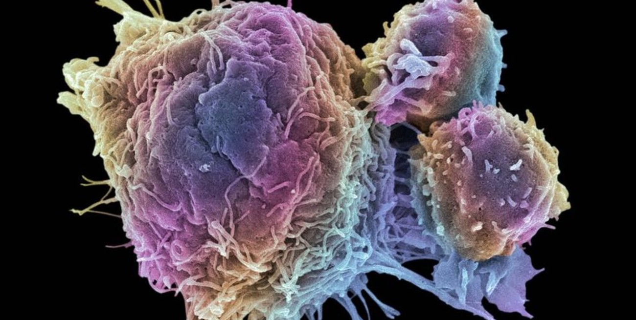 Avances en el tratamiento del cáncer de ovario
