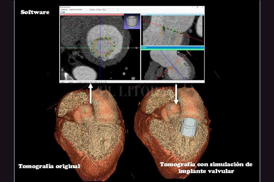 ELLITORAL_239655 |  Gentileza Hugo Paladini Abajo a la izquierda  vemos la reconstrucción en 3D del corazón de un paciente que se encuentra en evaluación para la colocación de una válvula cardíaca protésica. Se envía la imagen al software (Arriba) creado por el grupo de investigadores donde se selecciona el modelo ideal de válvula para implantar en el paciente. Abajo a la derecha, vemos el producto final: una reconstrucción del corazón del paciente con la válvula insertada  por el software. Esto permite previo a la cirugía real elegir la válvula ideal para cada paciente.