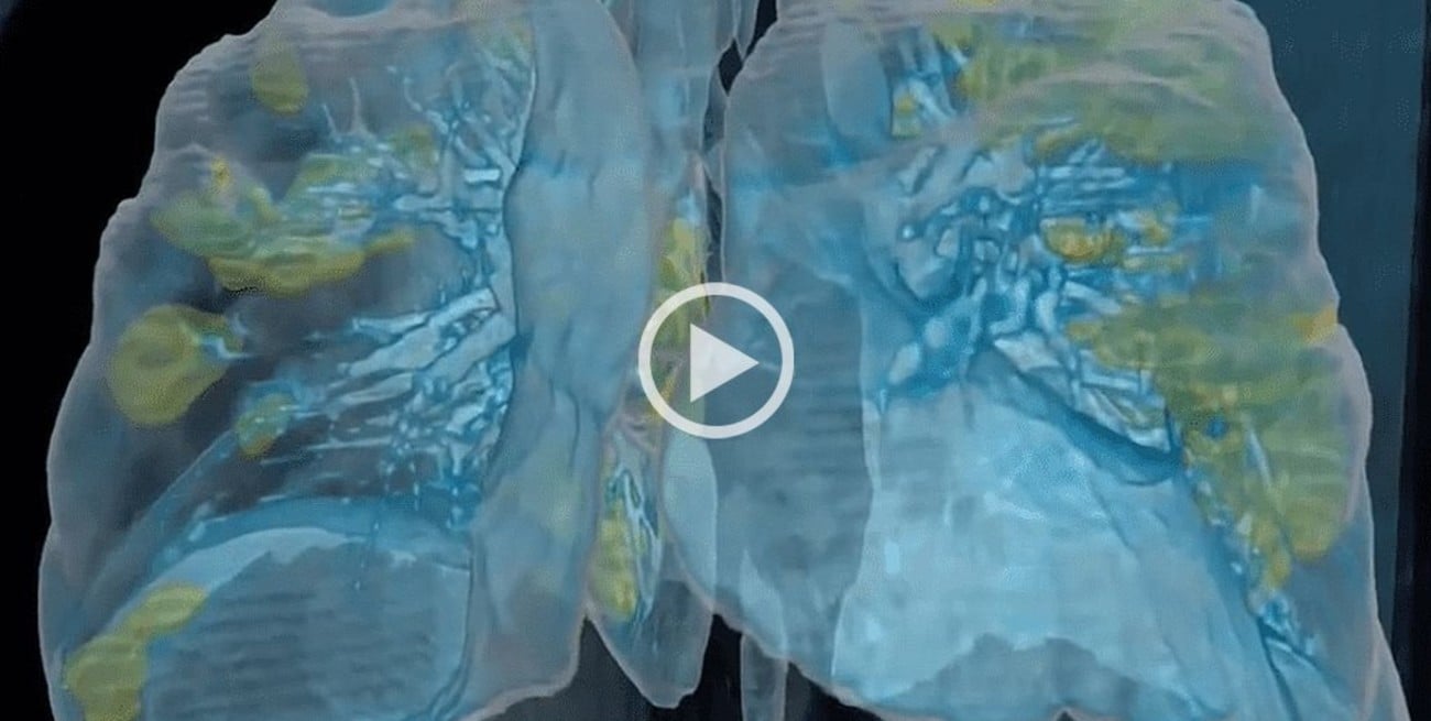 Un video en 3D revela cómo ataca el Covid-19 a los pulmones