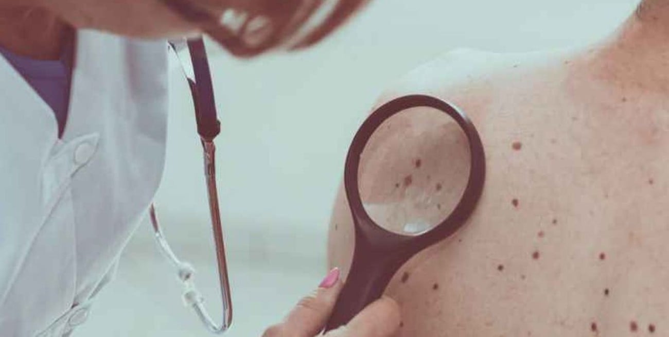 Advierten que disminuyeron los controles para prevenir el cáncer de piel por la pandemia