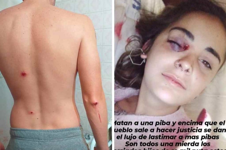 ELLITORAL_355130 |  Redes sociales Vecinos denunciaron en redes sociales las heridas causadas por la represión policial.