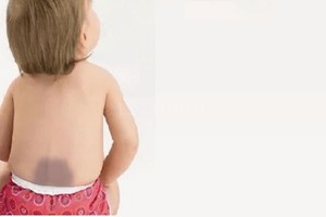 Archivo Ha pasado que las mal llamadas manchas mongólicas de ciertos bebés se confunden con hematomas, desencadenando una acusación de maltrato. No son nada.