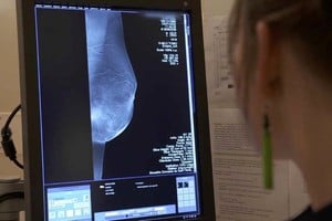 ELLITORAL_379061 |  Archivo La mamografía, el papanicolau y el test de sangre oculta son claves para detectar tres formas frecuentes de la enfermedad.