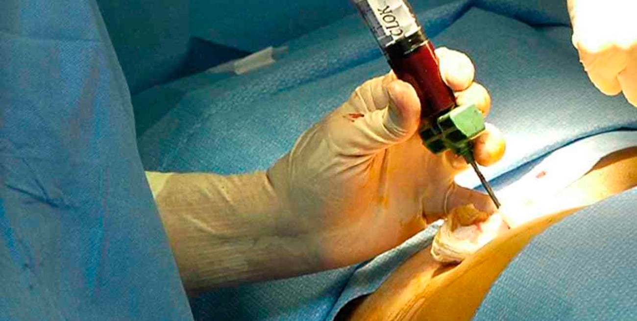 Desde 2003 se realizaron en el país 1.277 trasplantes de médula ósea de donantes no emparentados