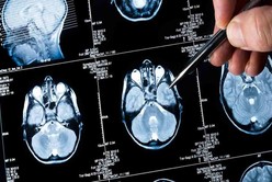 España: científicos hallaron una proteína que logra eliminar las células cancerosas del cerebro