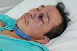 México: se detectó el primer caso de "hongo negro" en un hombre que se recupera de coronavirus 