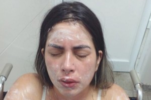 ELLITORAL_437683 |  Gentileza Así quedó la víctima luego de ser atendida por personal médico debido a las quemaduras sufridas, principalmente, en su rostro.