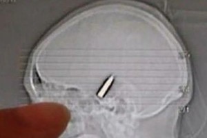 bala tomografia gentileza