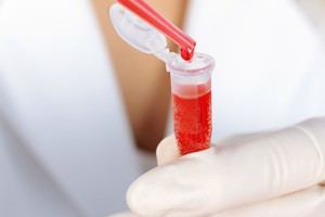 La hemofilia es una enfermedad genética que impide a la sangre coagular adecuadamente