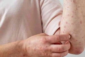 El contagio se produce a través del contacto cercano con piel infectada