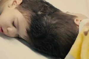 El histórico y complejo procedimiento que se realizó en Brasil para separar a dos gemelos siameses