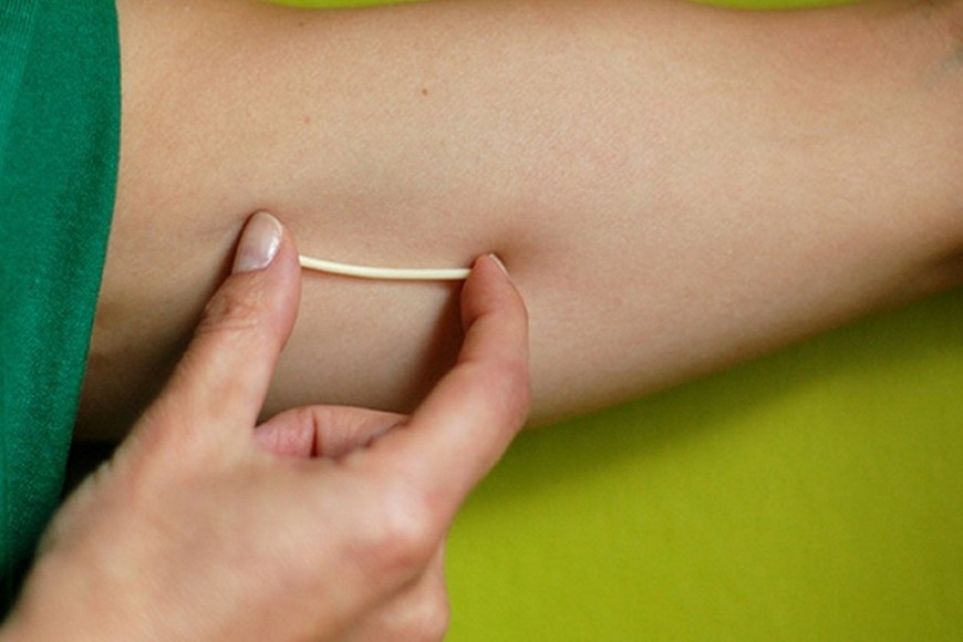 El implante dubdérmico se coloca por debajo de la piel del brazo