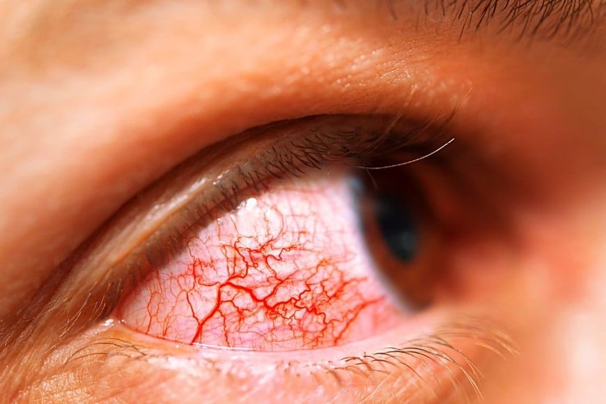 Se irrita e inflama la piel alrededor de los ojos