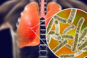 La enfermedad presenta diferentes cuadros de gravedad.