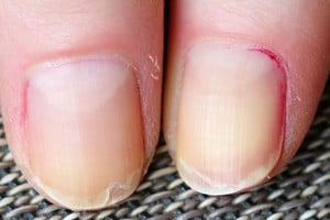 Las uñas descamadas pueden generar dolor o molestias