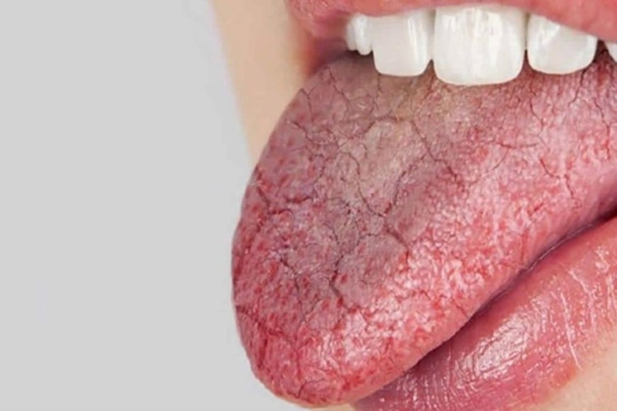 Los pacientes experimentan sequedad bucal, lo que puede dificultar hablar, tragar y masticar.