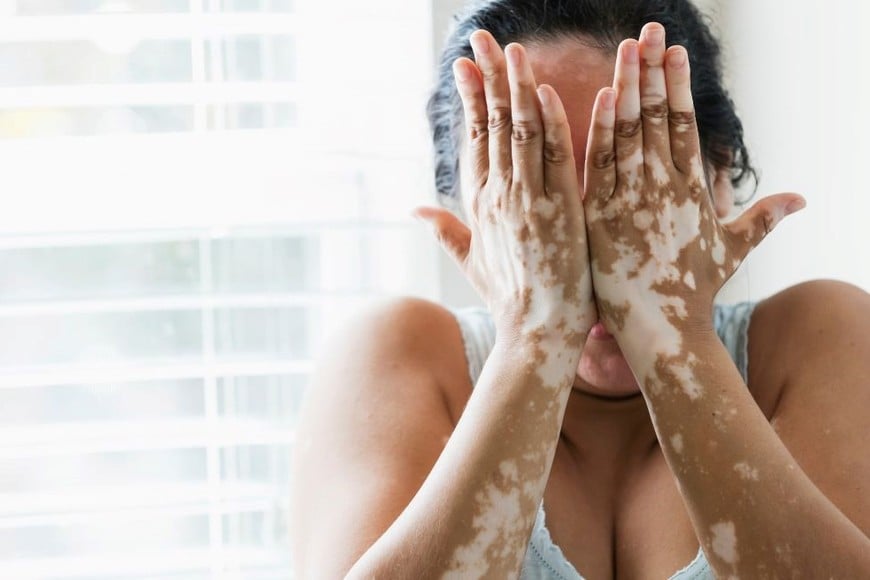 Tratar a los pacientes con vitiligo es un desafío, porque cada persona es única.