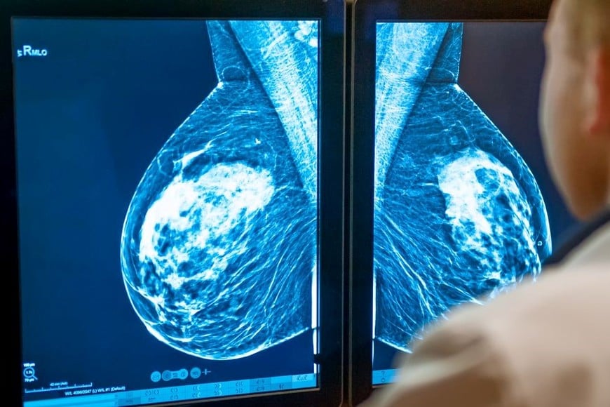 Estos programas  se aplican en mamografías.