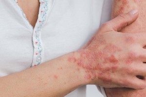 La psoriasis es una enfermedad inmunológica que provoca la formación de escamas en la piel que pueden producir picor o dolor. Crédito: Archivo.