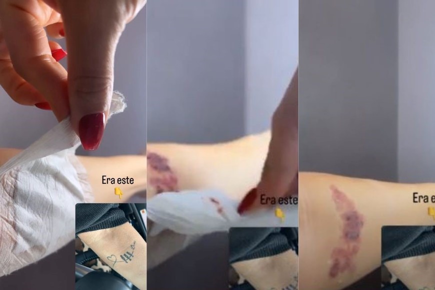La cicatriz que le quedó a la modelo tras borrarse un tatuaje.