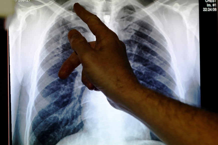 La bacteria de la tuberculosis afecta, en la mayoría de los casos, a los pulmones.