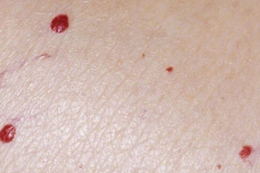 Algunas personas pueden optar por la eliminación por razones estéticas.