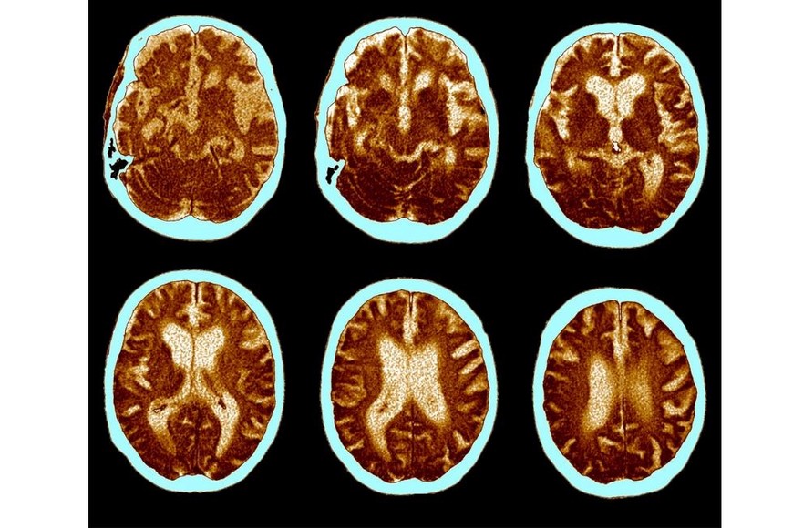 El Alzheimer es un trastorno neurológico que ocasiona la degeneración del cerebro,.