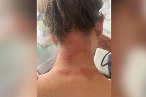 El insecto produce  irritabilidad local y súbita en la piel que se caracteriza por ardor o quemazón y lesiones eritematovesiculosas.