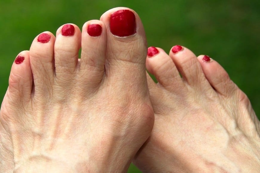 Las mujeres son más propensas a padecer juanete.