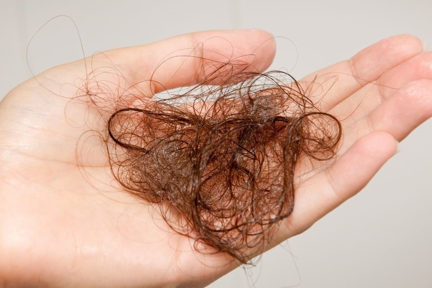 Distintos tipos de tratamientos pueden ayudar con la detección o el retraso de la pérdida genética capilar.