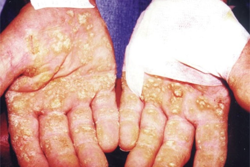 La franja oeste de la provincia de Santa Fe tiene napas saturadas en sales, entre ellas el arsénico. Su consumo lleva al Hidroarsenicismo Crónico Regional Endémico (HACRE).  La región requiere de agua potable transportada desde un afluente del Paraná, el río San Javier. El gobierno nacional le da la espalda a una obra para 150 mil santafesinos. Las empresas  contratistas ya abandonaron sus obradores. Hubo 100 despidos. Crédito: Archivo El Litoral