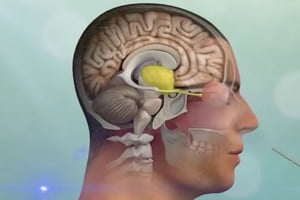 En el Hospital Cullen de Santa Fe se desarrolla un tratamiento de tumores cerebrales.