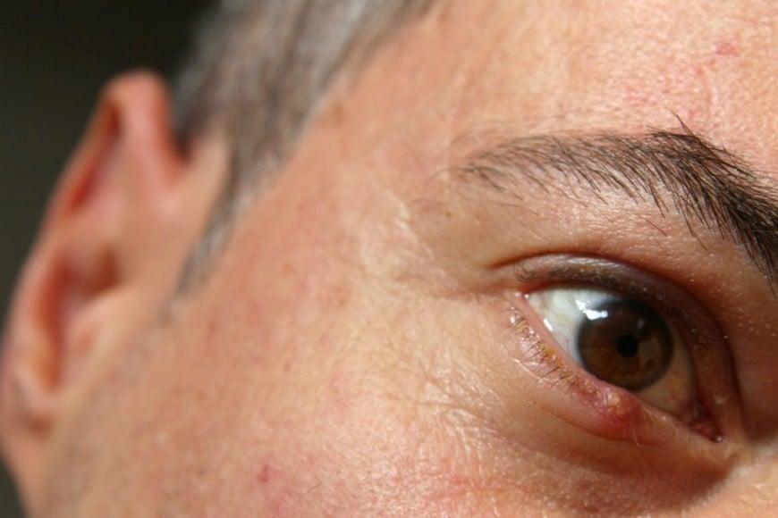 El orzuelo, es un problema incómodo y a menudo doloroso.