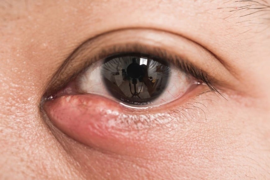 Inflamaciones en los párpados.