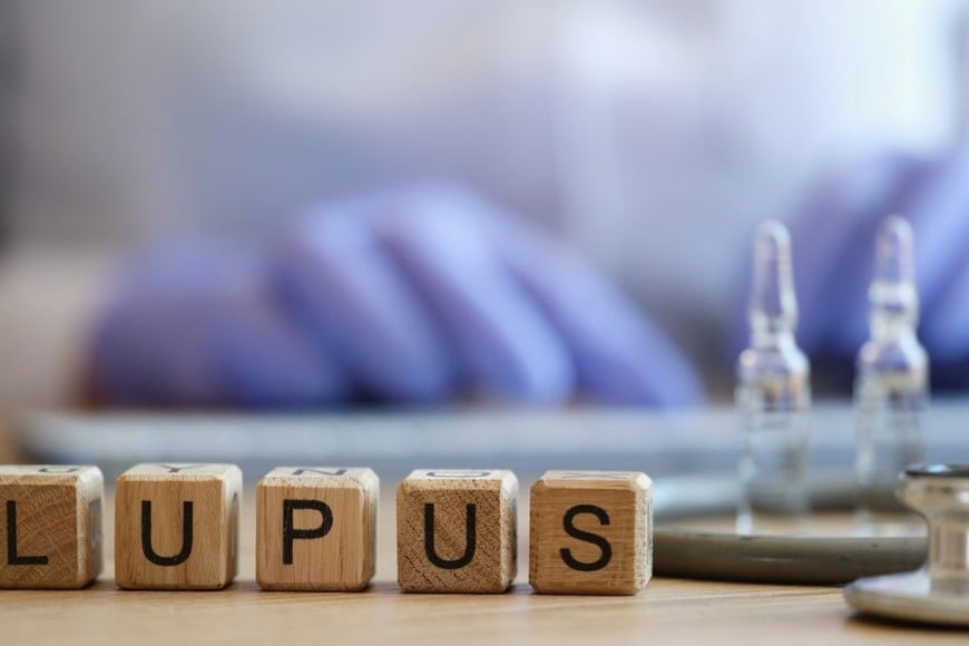 El diagnóstico de lupus puede ser desafiante.